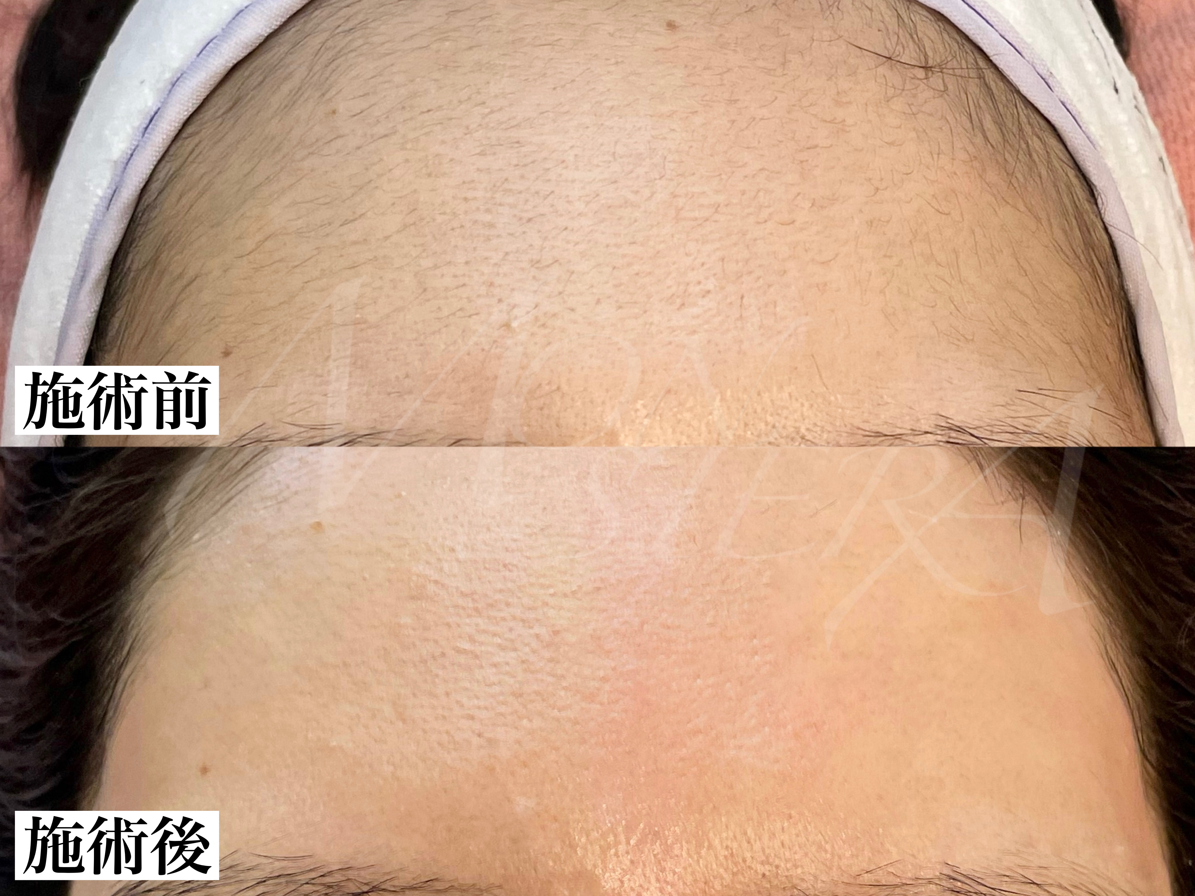 フェイシャルワックス